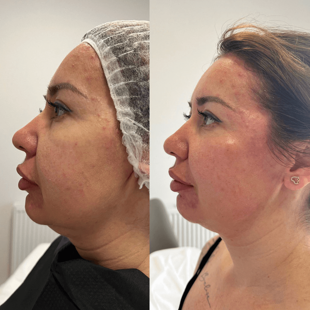 Efekty zabiegu Radiesse