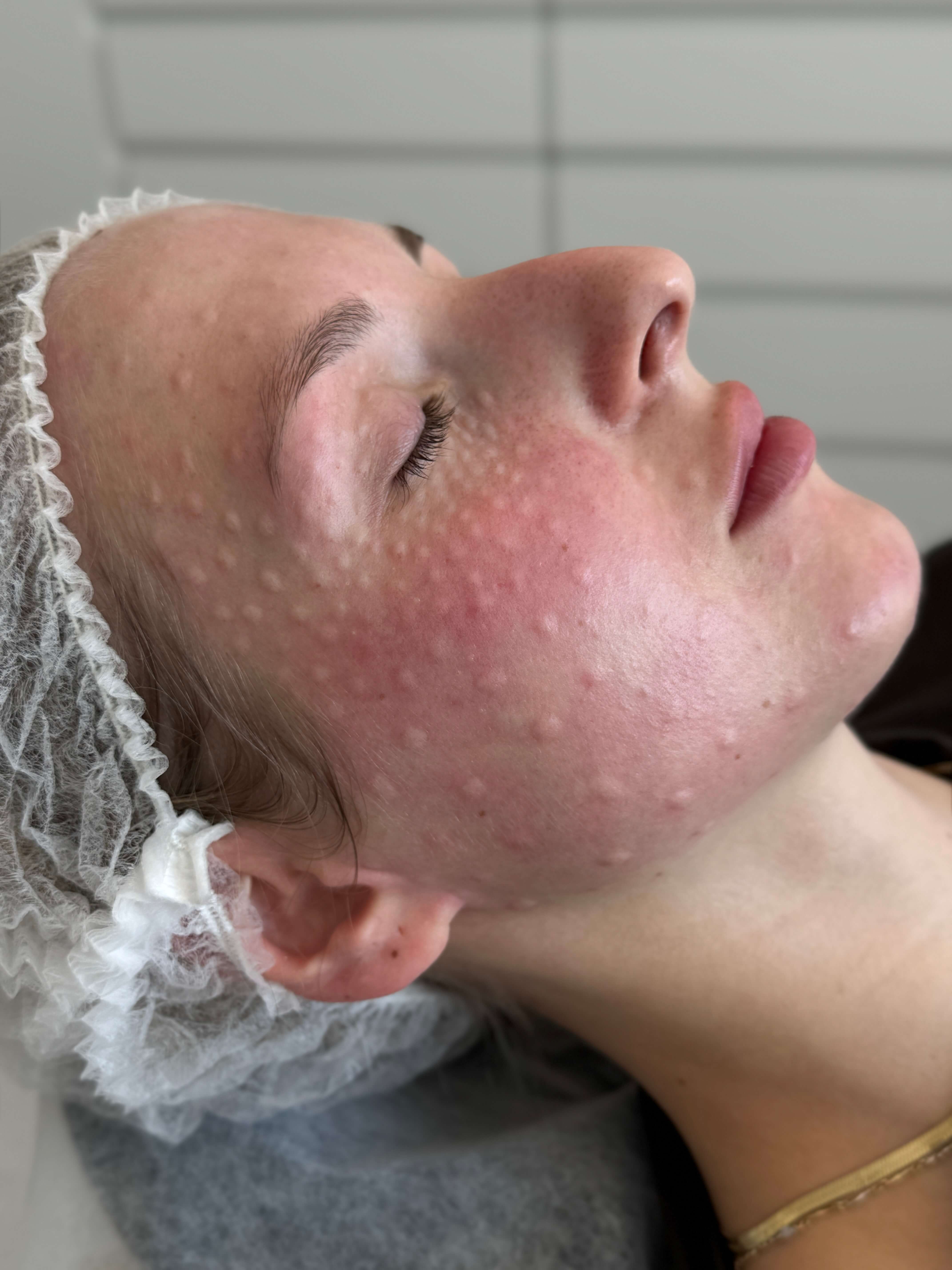 Polinukleotydy (PN/PDRN) Wrocław – jak działają i dla kogo są najlepsze