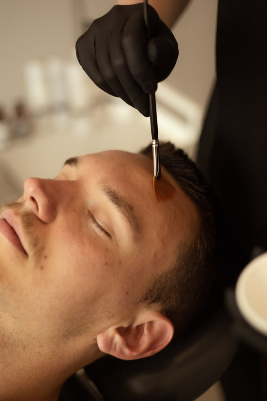 PCA Skin – terapia trądziku i trądziku różowatego